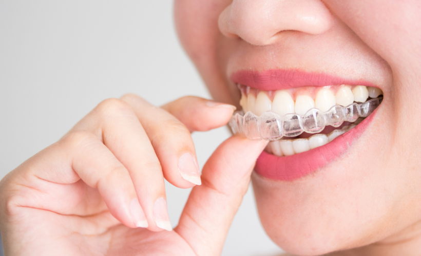 Invisalign Aligners