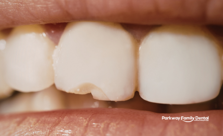 Dental Bonding in Windsor